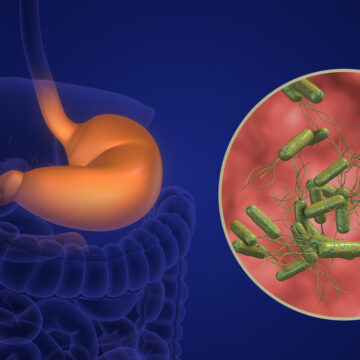 Vėžį galinčios sukelti skrandžio bakterijos įkaitais esame daugelis: gydytoja paaiškino, kaip tam užkirsti kelią