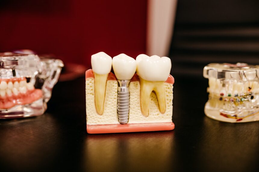 Pasiruošimas dantų implantavimo procedūrai: Patarimai ir geriausia praktika